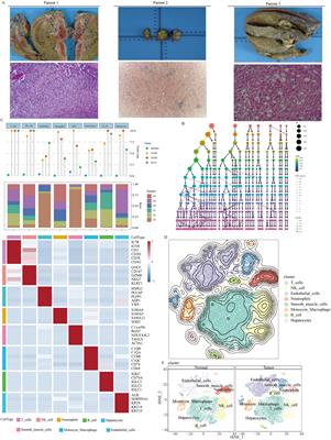 Unraveling the role of ADAMs in clinical heterogeneity and the immune microenvironment of hepatocellular carcinoma: insights from single-cell, spatial transcriptomics, and bulk RNA sequencing